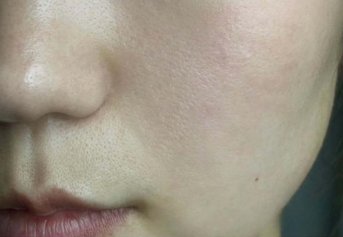 wrinkle-after wrinkle-after