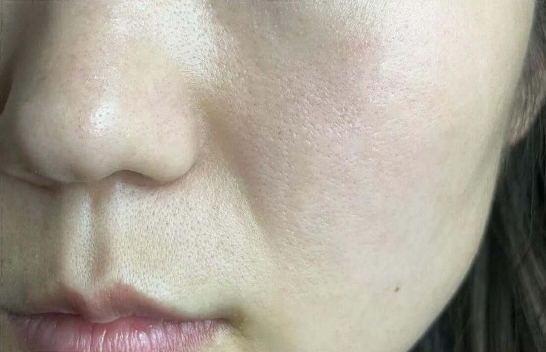 wrinkle-before wrinkle-before